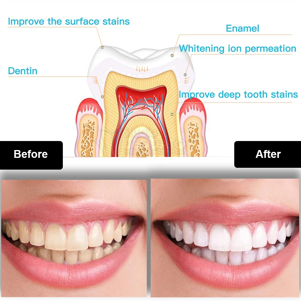 Dental Teeth Whitening Kit Min - огляд і ціна Teeth Whitening Laser